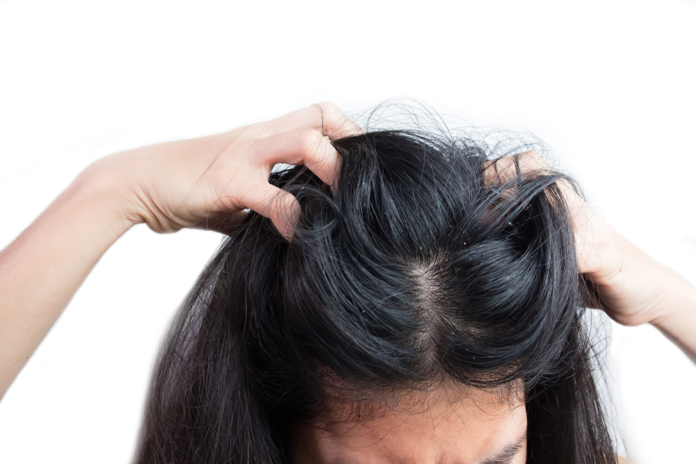 Benarkah Jarang Keramas Bikin Rambut Jadi Ketombean?