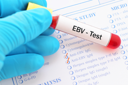Penelitian Ungkap Virus Epstein-Barr Bisa Sebabkan 7 Penyakit Serius Ini