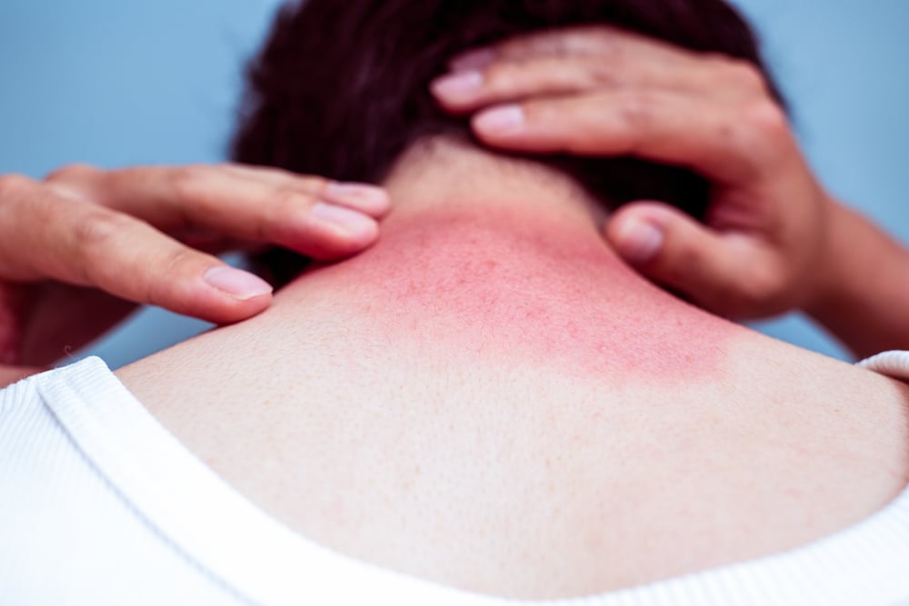 efek samping diflukortolon valerat bisa sebabkan munculnya sensasi terbakar pada kulit