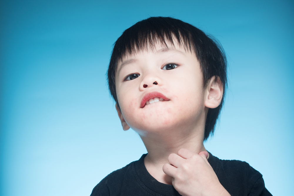 Muncul Ruam Merah di Sekitar Mulut Anak, Bagaimana Mengatasinya?