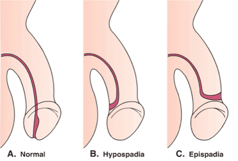 lubang penis tidak normal, epispadia hipospadia