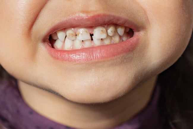Penyebab Fluorosis pada Gigi Anak dan Cara Mengatasinya