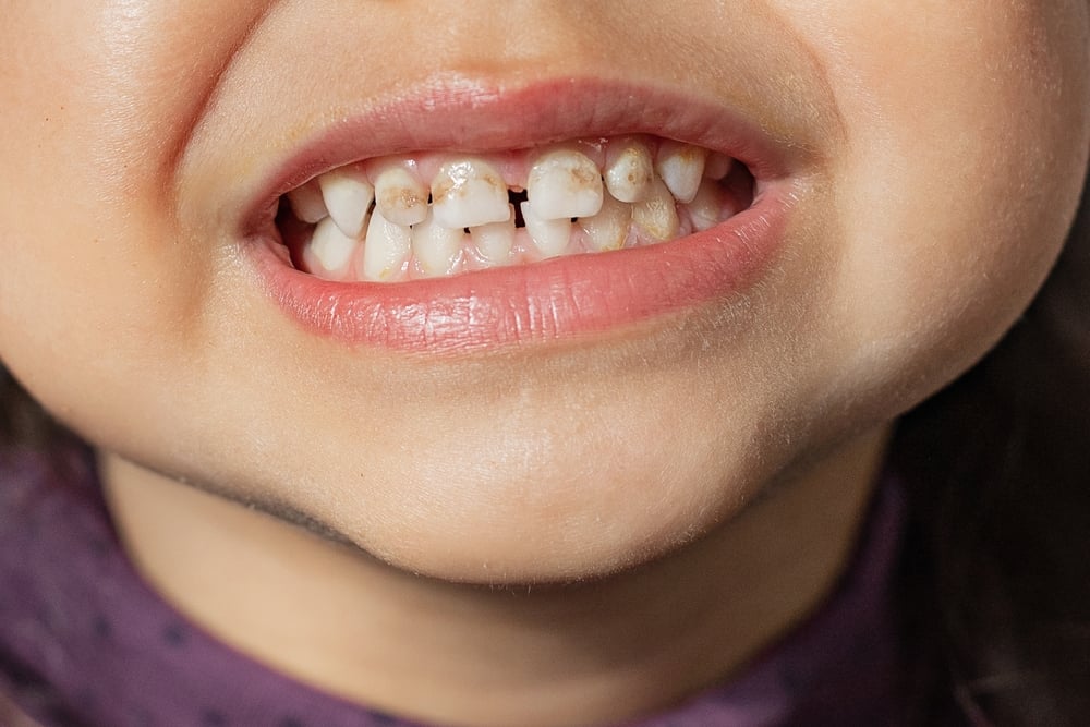 fluorosis gigi anak