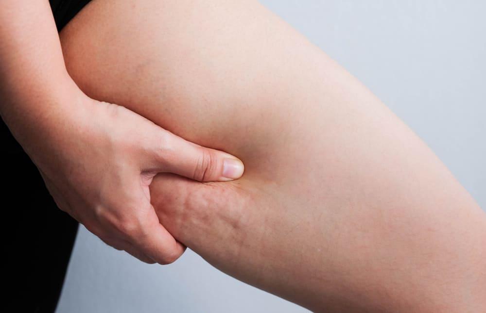 4 Kiat Menghilangkan Selulit yang Paling Ampuh dan Efektif