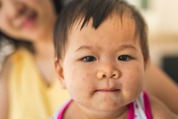 Gejala Campak Pada Anak Apa Yang Harus Orangtua Ketahui