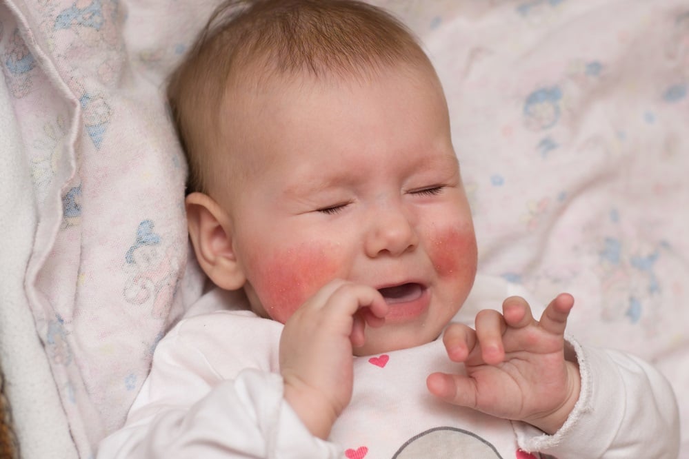 Penyebab Pipi Bayi Merah, Mulai dari yang Normal Sampai Perlu Diwaspadai