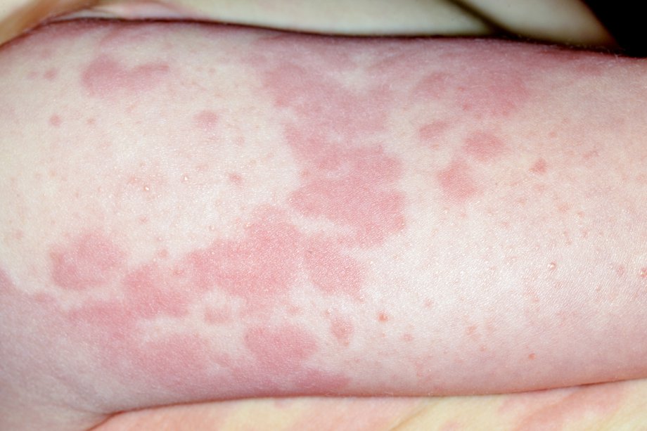 biduran penyakit kulit pada anak bayi