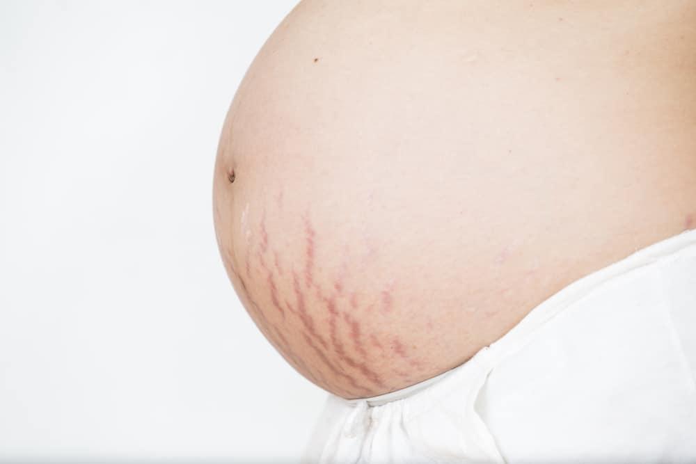 12 Cara Jitu Menghilangkan Stretch Mark Setelah Melahirkan