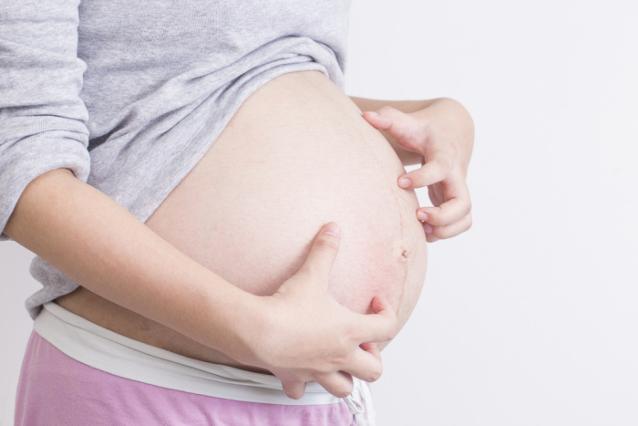 folikulitis pruritus adalah penyebab kulit gatal saat hamil