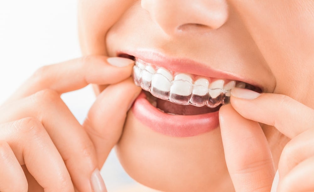 7 Hal yang Harus Anda Tahu Sebelum Pakai Invisalign untuk Merapikan Gigi