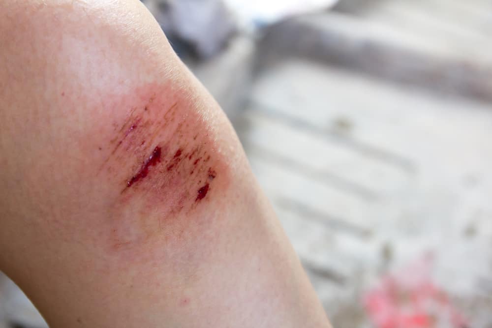 Foto luka di kaki berdarah