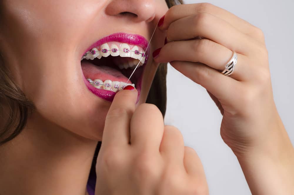 Manfaat Pakai Benang Gigi untuk Pengguna Behel
