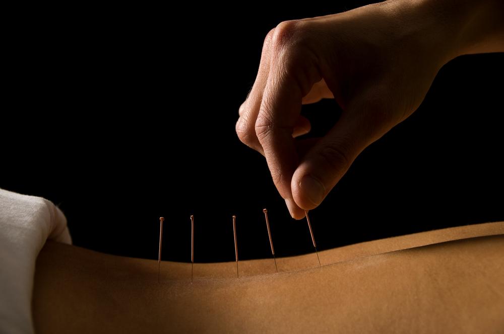 Redakan Sensasi Panas Akibat Menopause Dengan Akupunktur