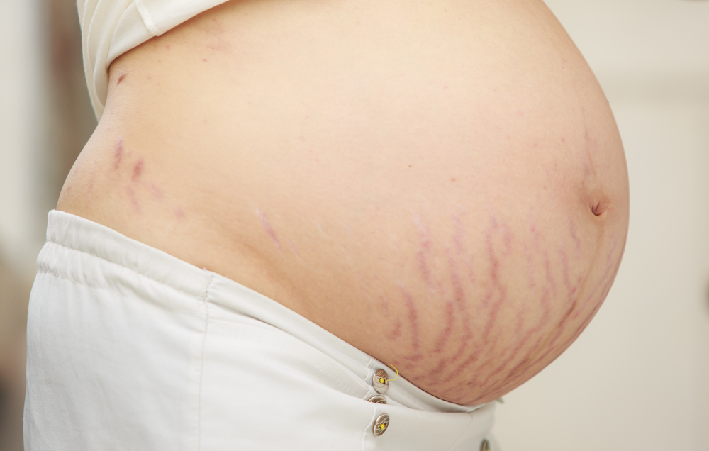 Sering Dikira Sama, Ini Perbedaan Selulit dan Stretch Mark