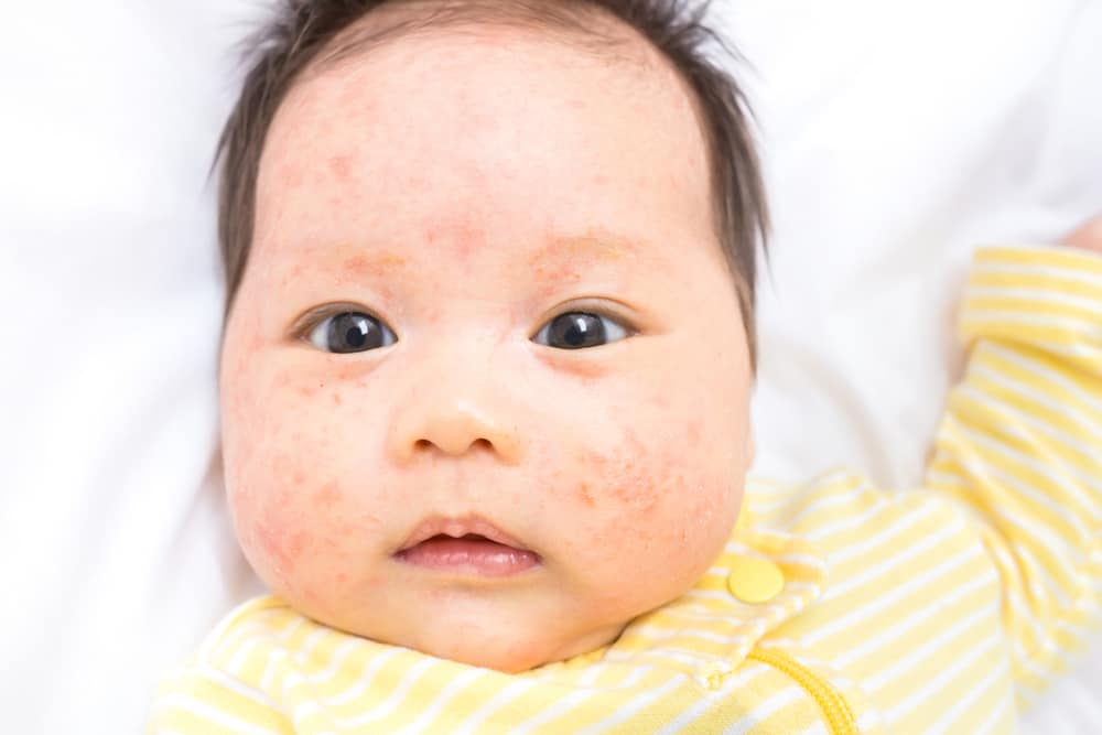 5 Gejala Utama Impetigo pada Kulit Anak