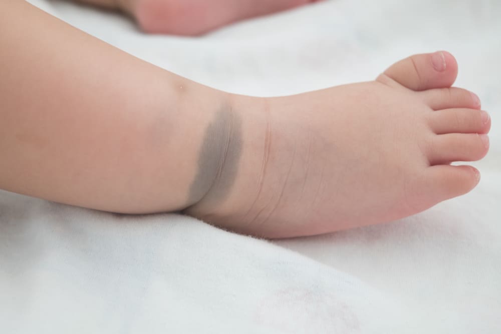 Tanda Lahir Pada Bayi Berwarna Biru Gelap Apa Artinya