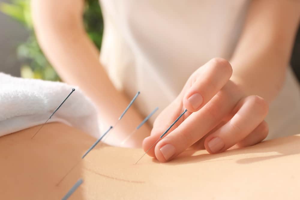 terapi akupunktur