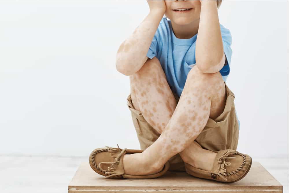 Waspadai Vitiligo Pada Anak, Samakah Dengan Orang Dewasa?