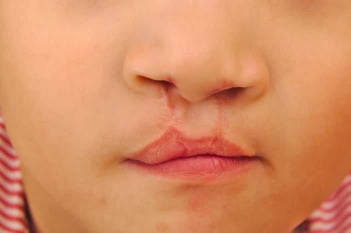 operasi bibir sumbing