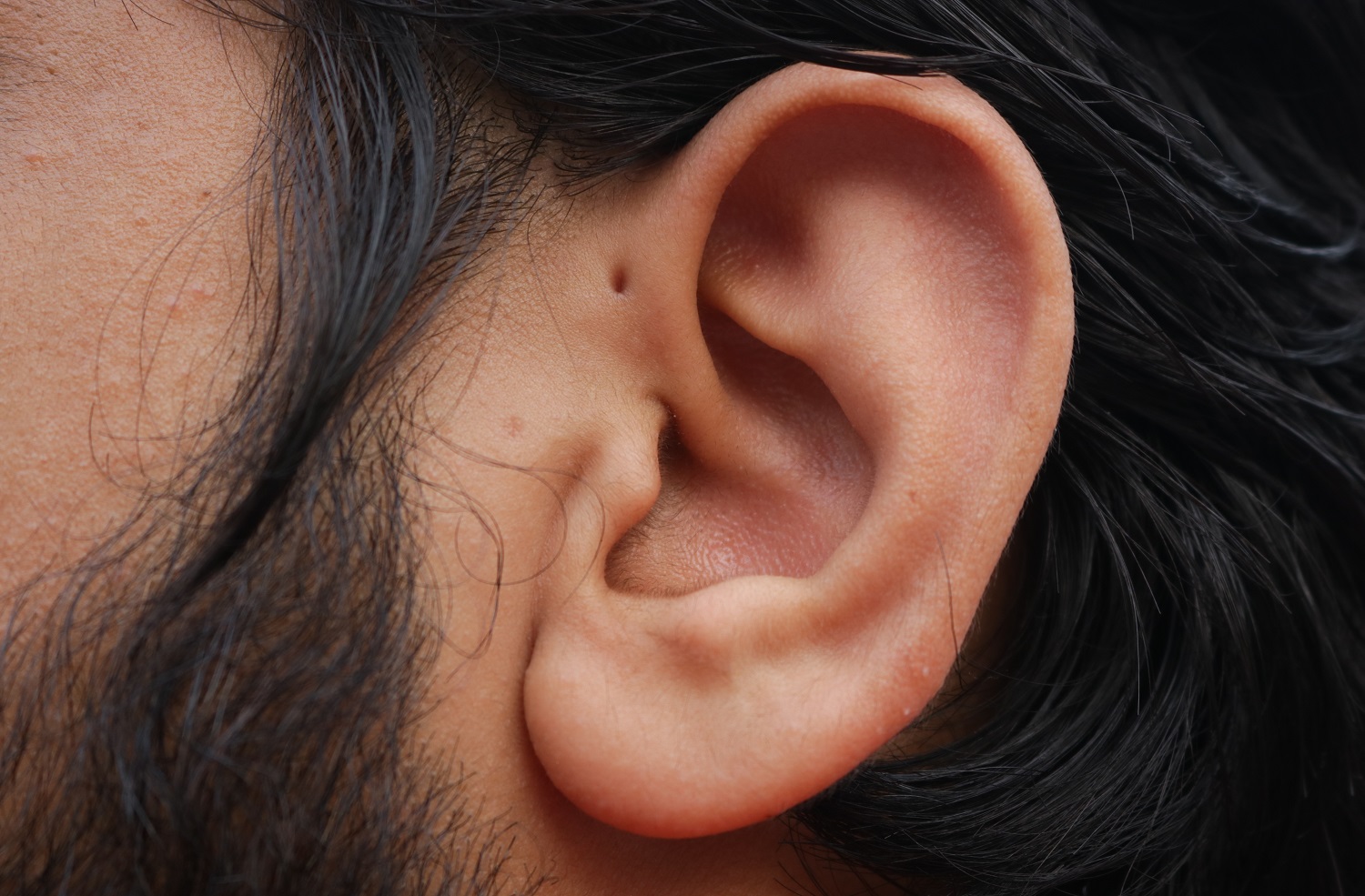 Mengenal Sinus Preauricular, Adanya Lubang pada Telinga