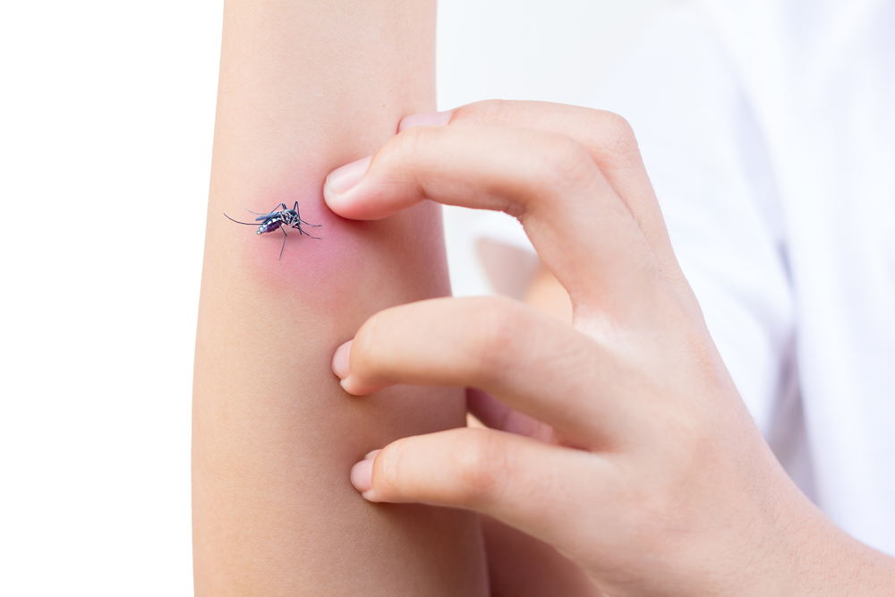 8 Cara Ampuh Menghilangkan Bekas Gigitan Nyamuk