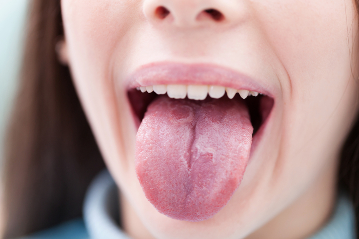 psoriasis lidah