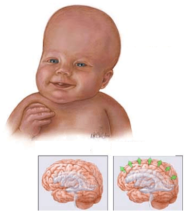 hidrosefalus jenis penyakit saraf anak