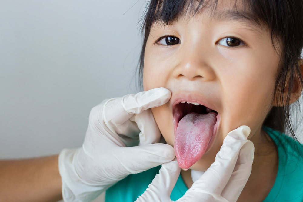 Oral Thrush, Infeksi Jamur di Mulut yang Bisa Menyerang Bayi dan Orang
Dewasa