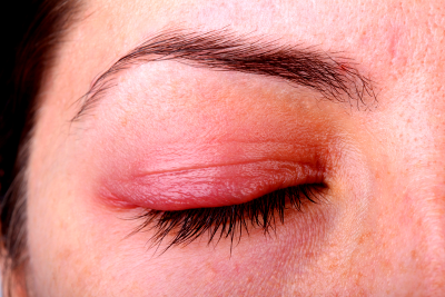 ocular rosacea