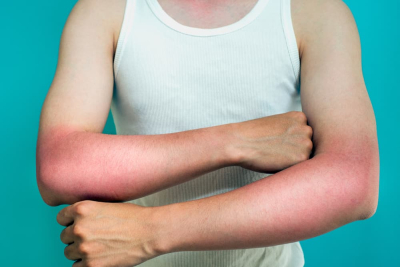 sunburn blister, kulit melepuh akibat terbakar sinar matahari