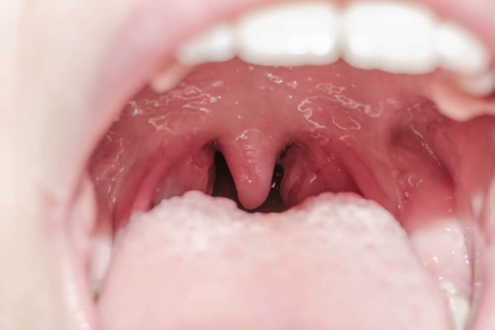 Mengenal Tonsil, Organ Kecil yang Berperan Penting Melawan Infeksi