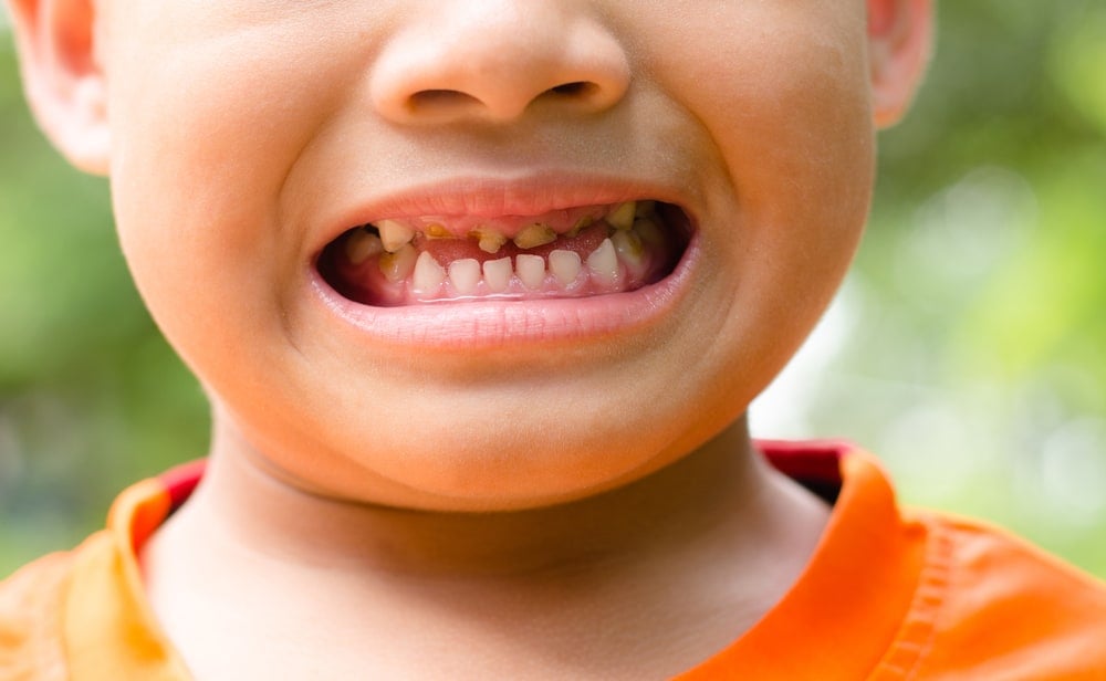 3 Penyebab Umum Mengapa Gigi Anak Rentan Kena Karies