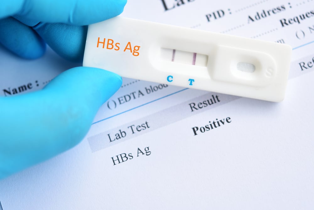HBsAg, Tes Darah untuk Mendiagnosis Penyakit Hepatitis B