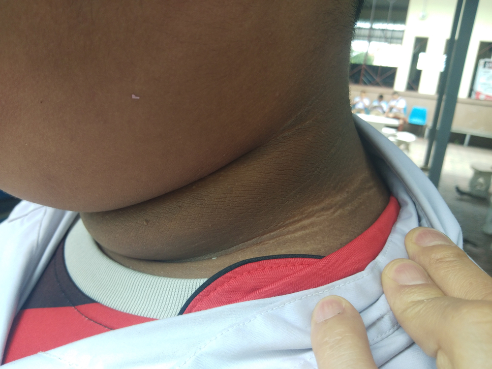 Acanthosis Nigricans