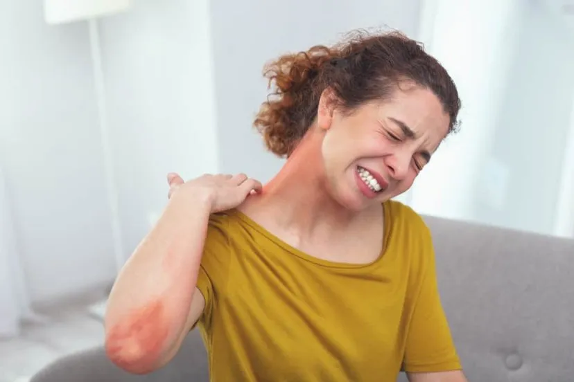 Sindrom Stevens-Johnson