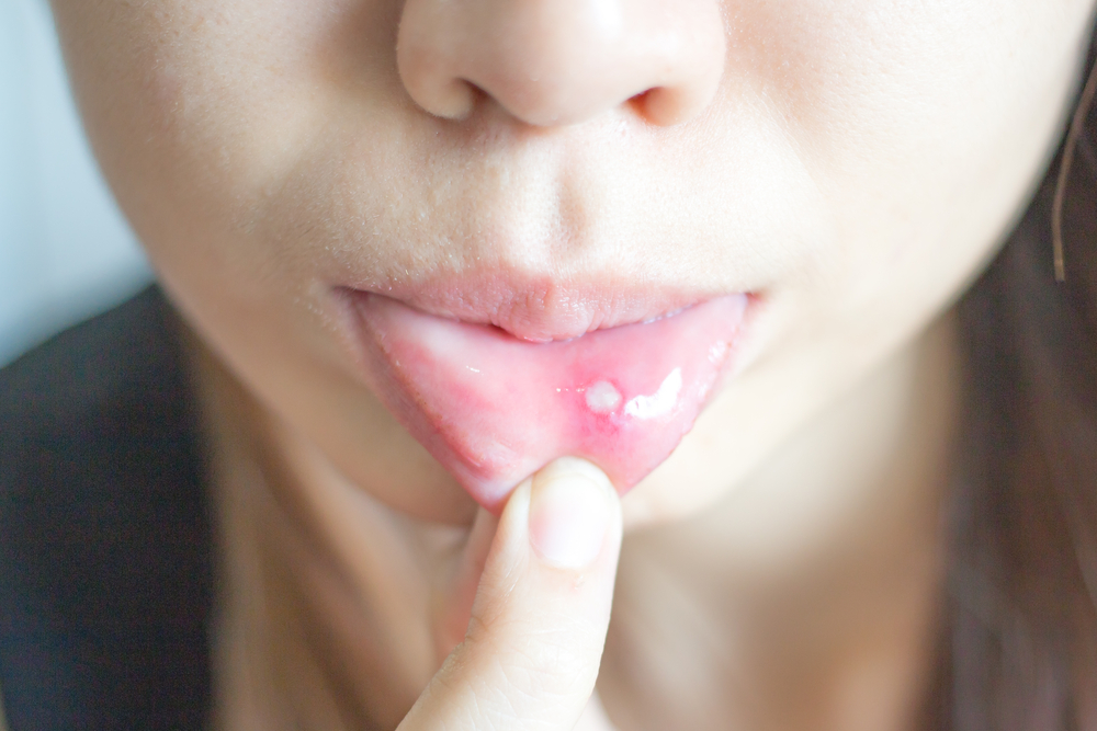 Kenali Perbedaan Sariawan Biasa dan Herpes di Mulut