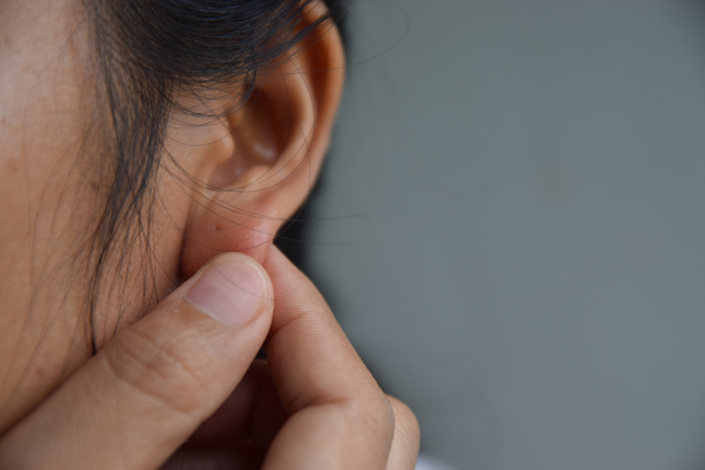 5 Tindakan Medis yang Efektif Menghilangkan Keloid yang Membandel di Telinga