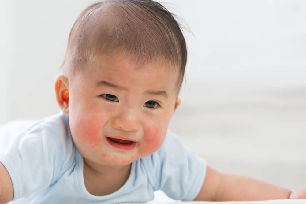 Iritasi Kulit Bayi, Kenali Penyebab dan Cara Mengatasinya