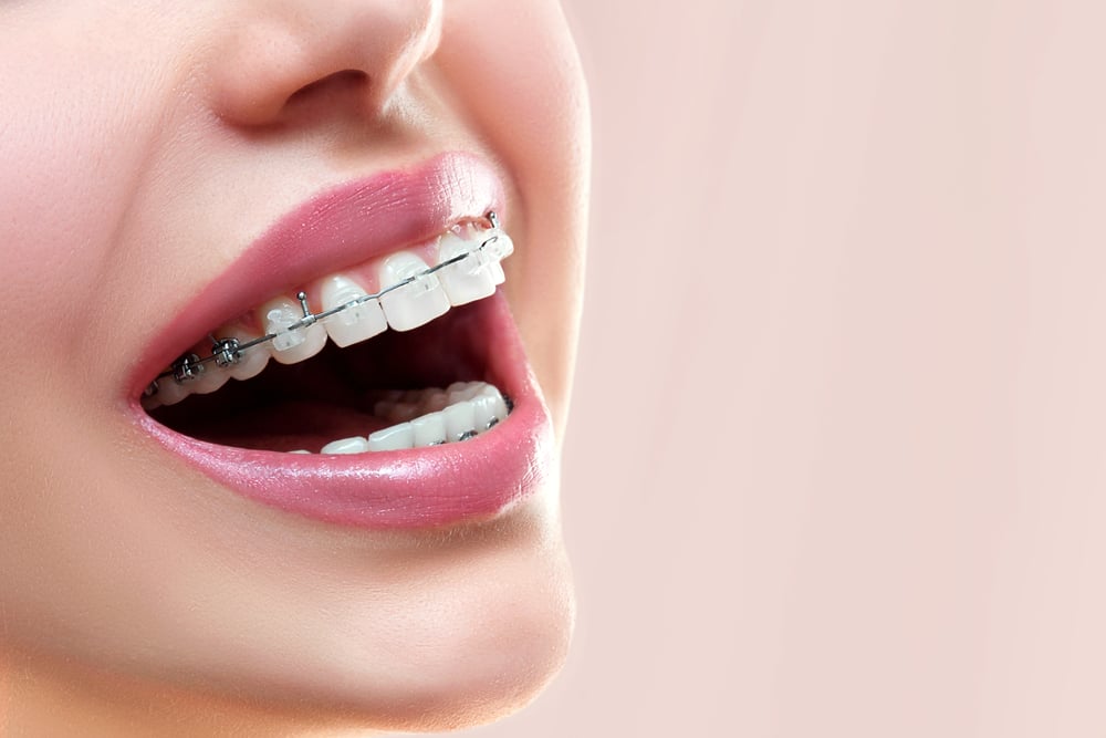 Merapikan Gigi dengan Behel dan Invisalign, Apa Bedanya?