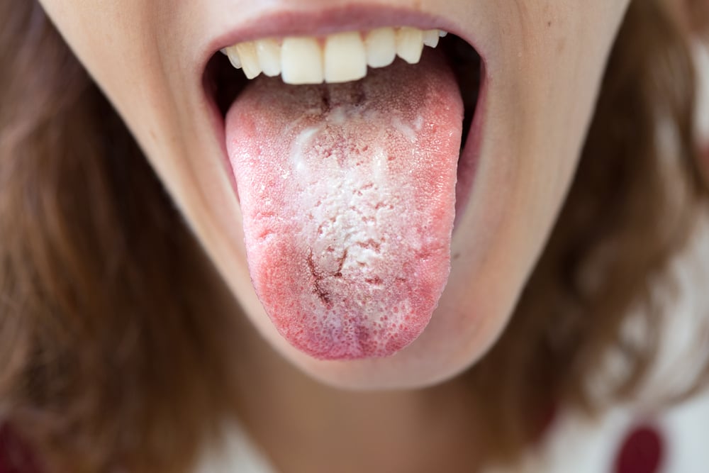 cara mengatasi lidah putih