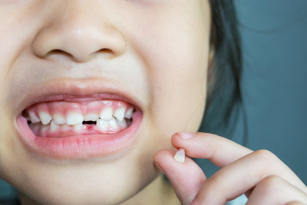 Kapan Gigi Si Kecil Akan Copot Pertama Kalinya?