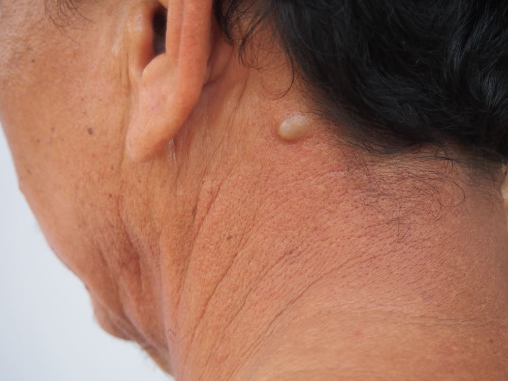benjolan di leher salah satu gejala kista epidermoid