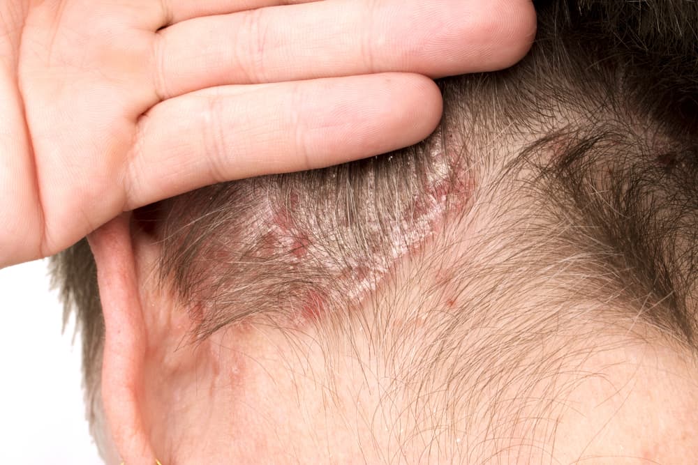 Psoriasis Kulit Kepala Penyebab Gejala Obat Dll