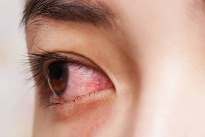 gejala toksoplasmosis pada mata
