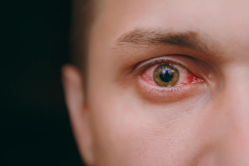 6 Penyebab Umum Mata Memerah Saat Pakai Softlens