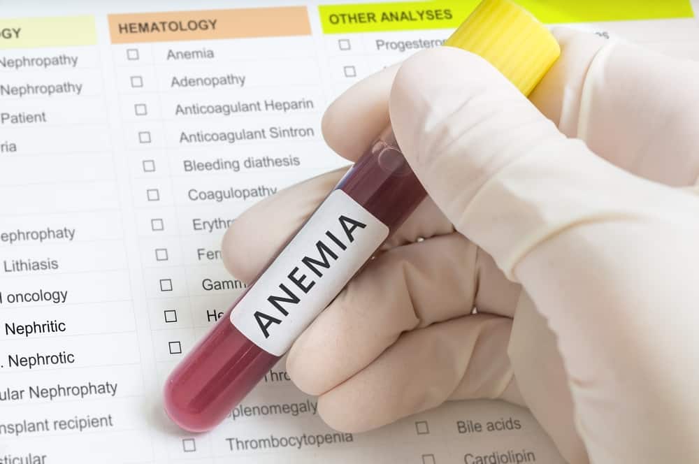 Berbagai Pilihan Pengobatan untuk Mengatasi Anemia