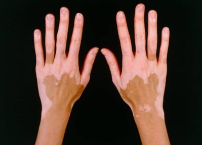 gejala vitiligo