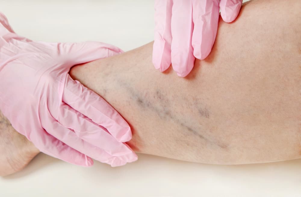 Jangan Abaikan Gejala Deep Vein Thrombosis, Ini Bahayanya