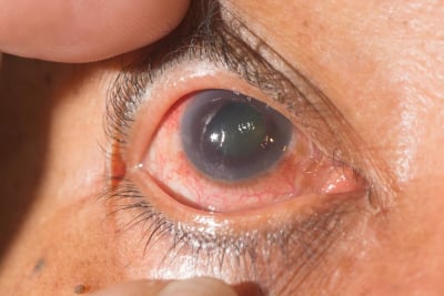 perawatan implan glaukoma