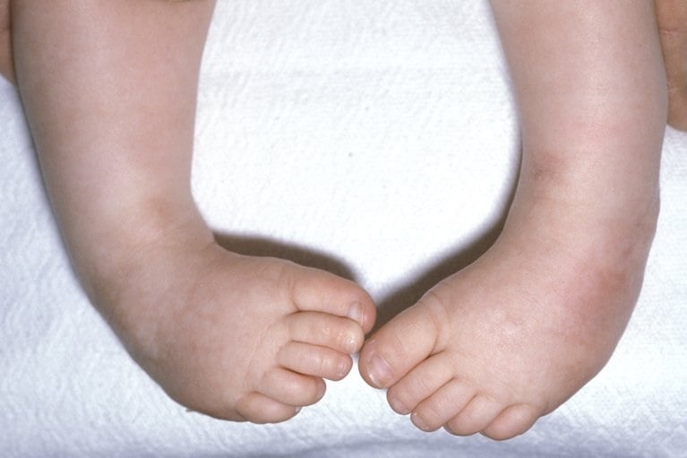 gambar kaki bayi bengkok